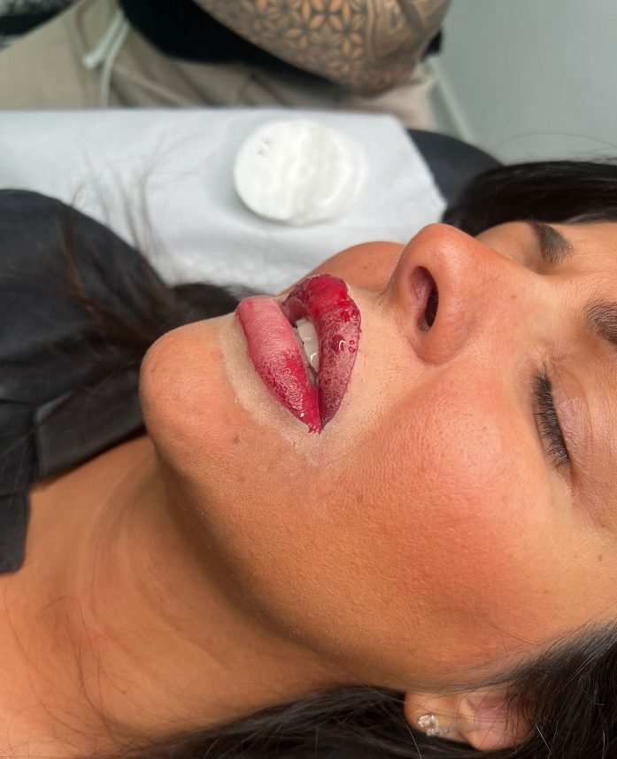 Lippenpigmentierung