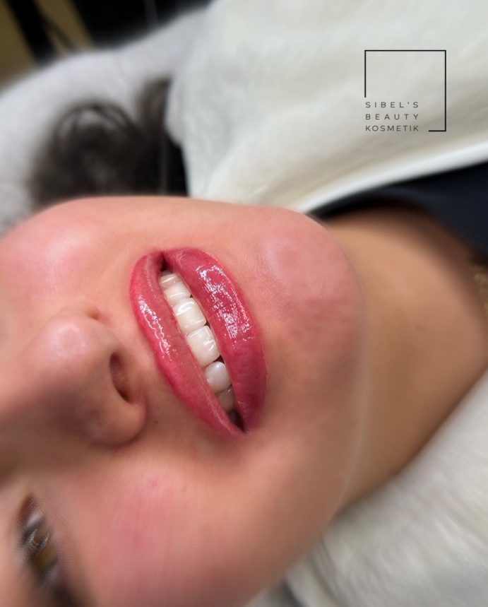 3D Lippen Volumen und Definition